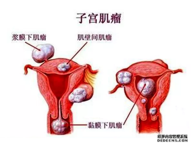 延吉拜城县子宫肌瘤初期有哪些症状表现
